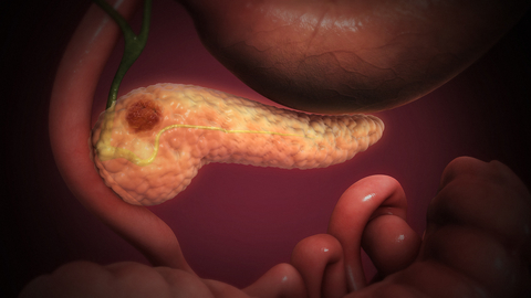 Pancreatic cancer Pancreatic cancer
