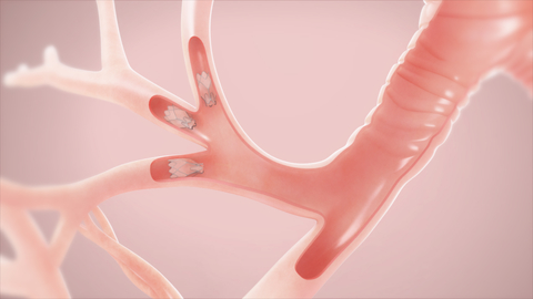 Pulmonx’s Zephyr Endobronchial Valve Pulmonx’s Zephyr Endobronchial Valve