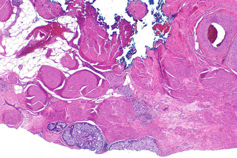 Bladder Cancer Bladder Cancer