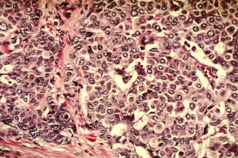Breast Cancer Cells Breast Cancer Cells
