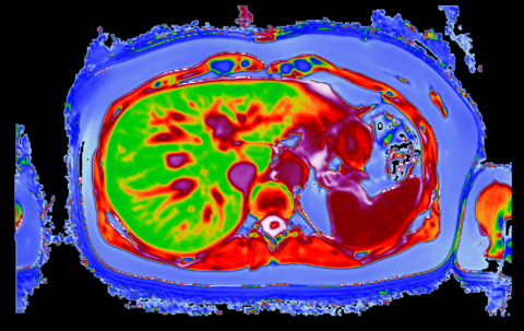 LiverMultiScan image of patient with fatty liver disease post bariatric surgery LiverMultiScan image
