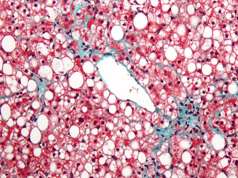 NASH Non-alcoholic fatty liver disease