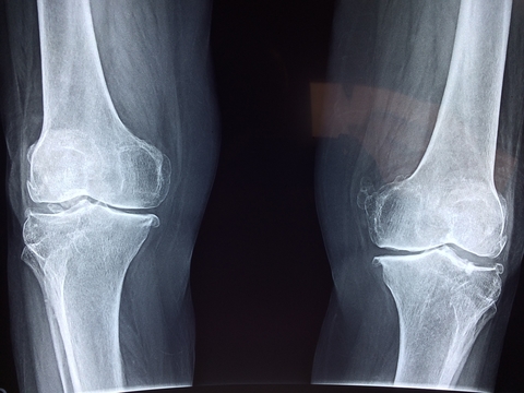 knee x-ray knee x-ray