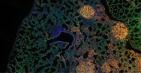 MIT lung cancer image Lung cancer