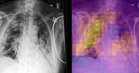 AI scans chest X-rays for covid AI scans chest X-rays for covid