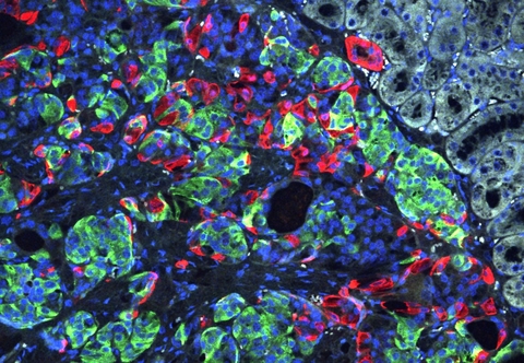CRISPR diabetes CRISPR diabetes