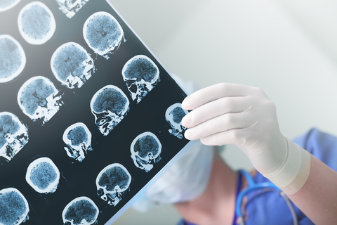 Alzheimers disease aging
