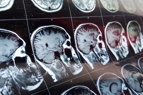MRI brain scan MRI brain scan