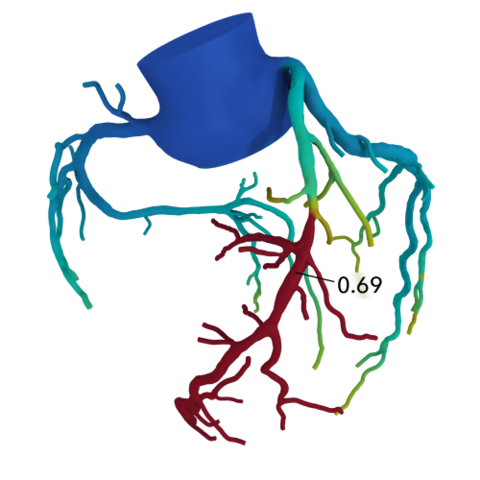 HeartFlow Analysis HeartFlow Analysis