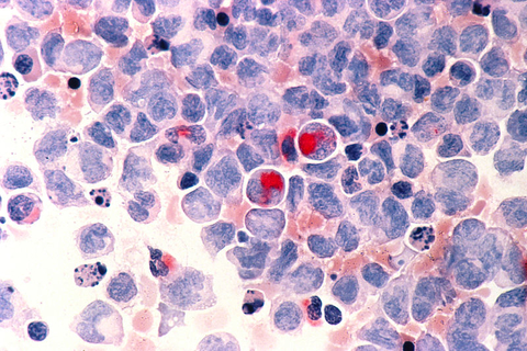 Acute myeloid leukemia Jazz Vyxeos AML