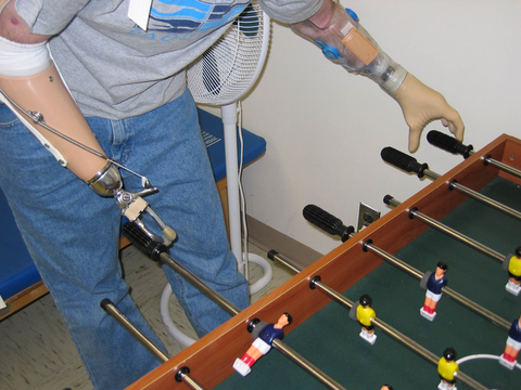 Prosthetics Advances in prosthetics are seeing conventional cable-operated prostheses (left) giving way to myoelectric versions (right