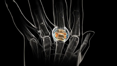 Pfizer Xeljanz rheumatoid arthritis RA joint damage Pfizer Xeljanz