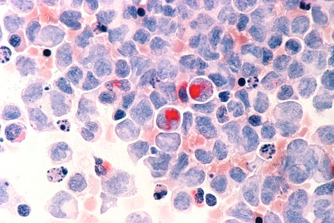 Acute myeloid leukemia Jazz Vyxeos AML