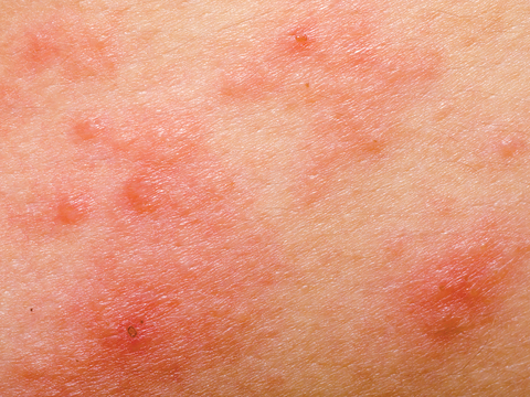 Atopic Dermatitis Atopic Dermatitis