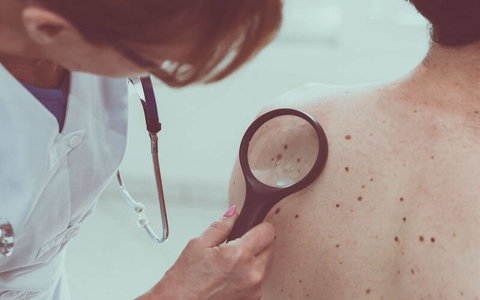 Skin Cancer Screening 