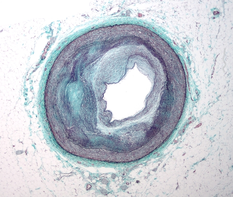 Atherosclerosis Atherosclerosis
