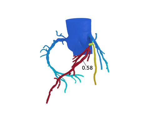HeartFlow FFRct software 3D map 3D, color-coded map of the coronary arteries showing blood flow