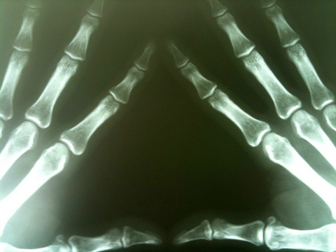 bones hands Michael Dorausch/CC BY-SA 2.0 x-ray of hand bones