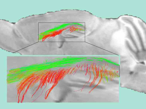Alzheimer's white matter Alzheimer's white matter