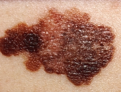 Melanoma Melanoma