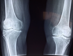 knee x-ray knee x-ray