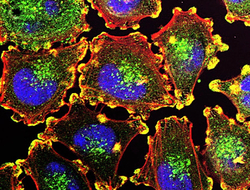 metastatic melanoma cells - National Cancer Institute melanoma