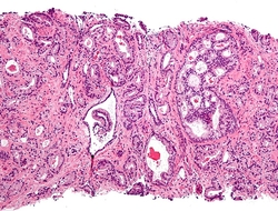 Prostate cancer--Courtesy of Michael Bonert CC BY-SA 3.0 Micrograph showing the most common prostate cancer