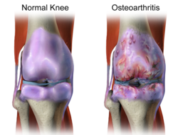 osteoarthritis osteoarthritis