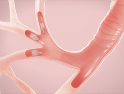 Pulmonx’s Zephyr Endobronchial Valve Pulmonx’s Zephyr Endobronchial Valve