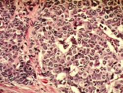 Breast Cancer Cells Breast Cancer Cells