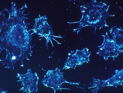 Cancer cells in electron microscope scan Cancer cells in electron microscope scan