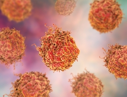 Prostate Cancer Prostate Cancer